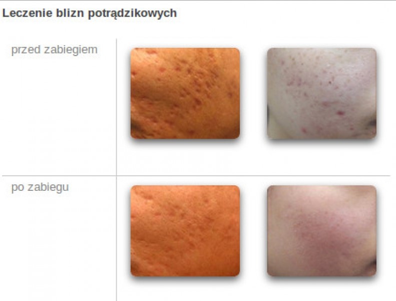 Dermatologia Estetyczna Warszawa Przed